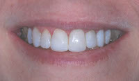 Composite Bonding 6 teeth close up final