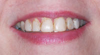 Composite Bonding 6 teeth close up