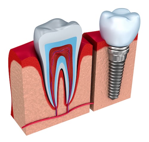 dental implant diagram illustration
