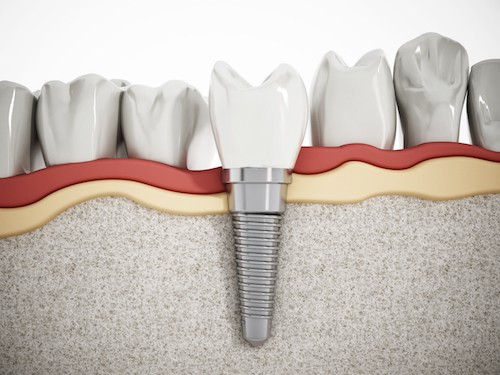 dental implant failure diagram