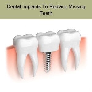 Dental Implants To Replace Missing Teeth