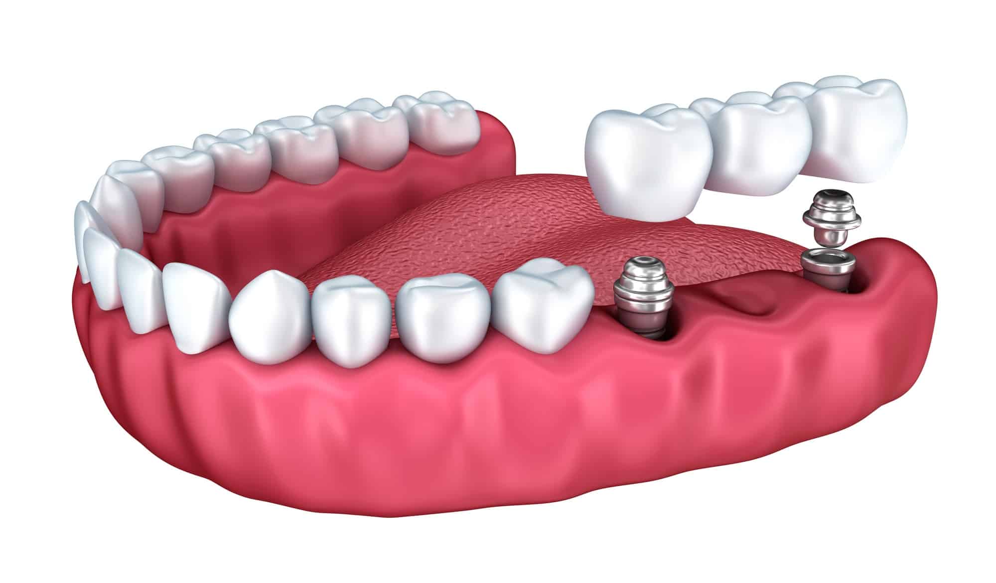 dental crown added to implant on teeth